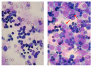 Knockdown of normal MLL gene in human leukemia cells reduces leukemic infiltration in mouse bone marrow (left), compared with heavy leukemic infiltration in marrow from leukemia cells with normal MLL gene (right). Arrows denote leukemic cells.  (Peter Blessington, University of Pennsylvania School of Medicine)